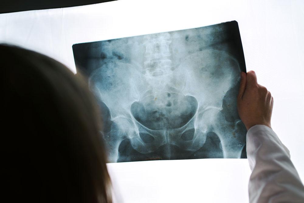 Hip xray